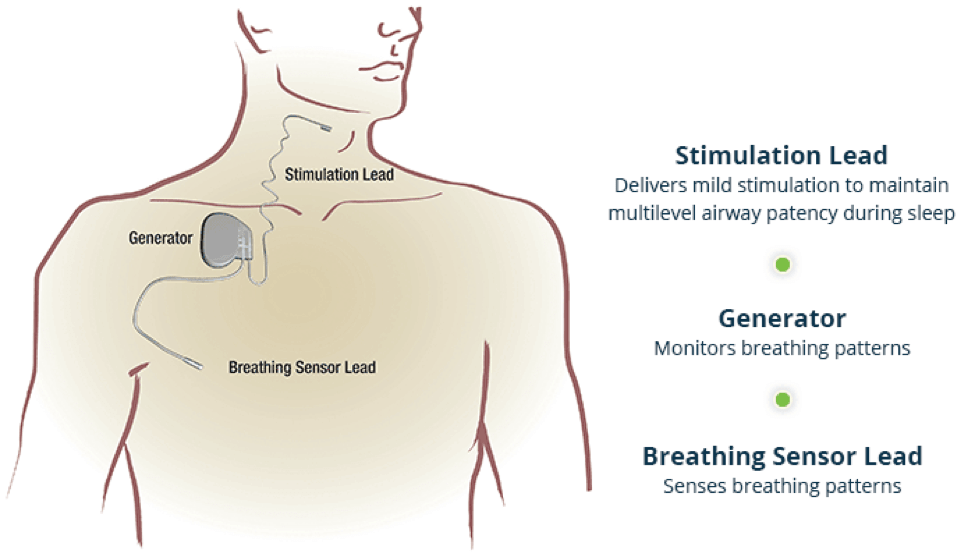 inspire treatment sleep apnea